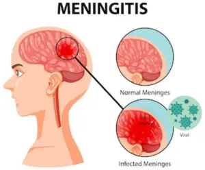 What is Meningitis